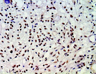 ATRX Antibody Immunohistochemistry on a FFPE Astrocytoma Tissue